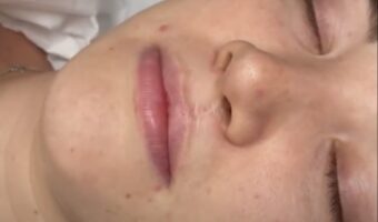 Makijaż permanentny ust po rozszczepie wargi