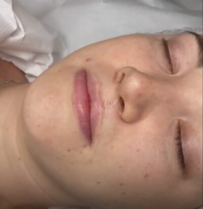 Makijaż permanentny ust po rozszczepie wargi